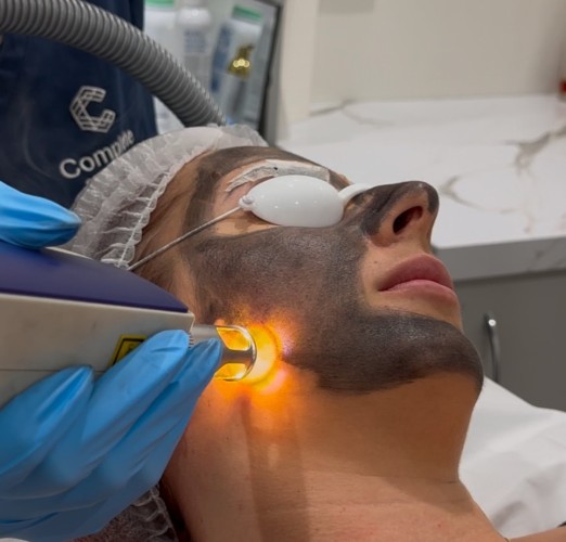 Carbon Laser: Delivering Radiant and Clear Skin